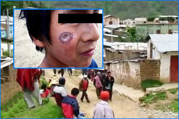 Yungay: Brote de 40 nuevos casos de uta en Quillo expone la ausencia de la Diresa – Áncash